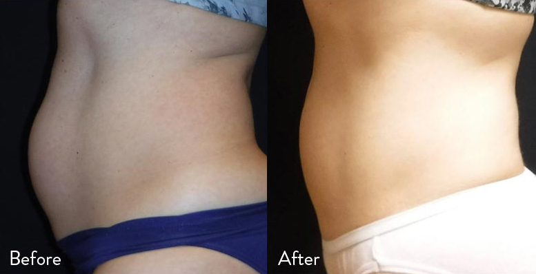 before-after-evolvex